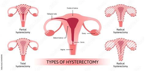 Vaginal Hysterectomy .
